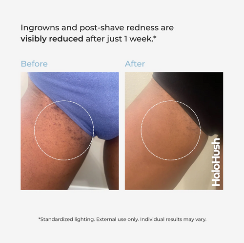 Smoothing Solution Ingrown Hair Treatment