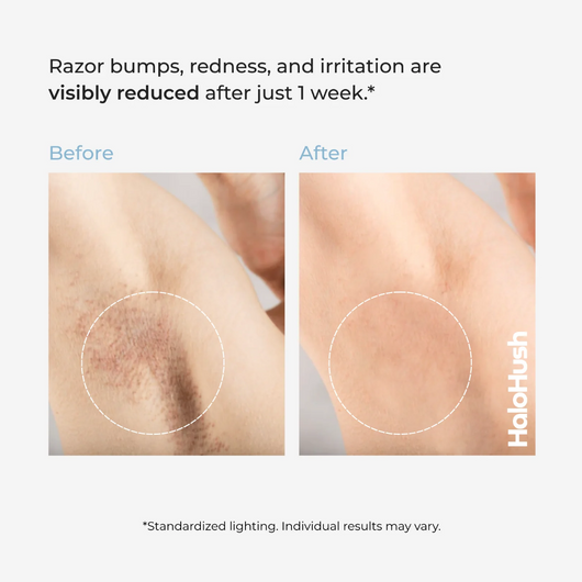 Smoothing Solution Ingrown Hair Treatment